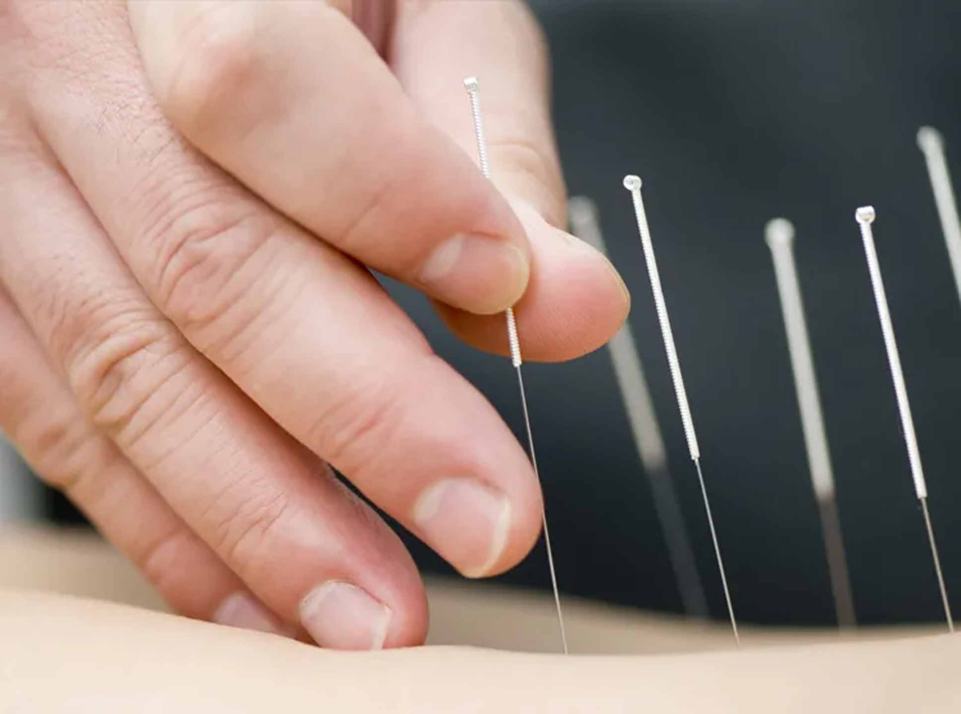 acupuncture-1.jpg